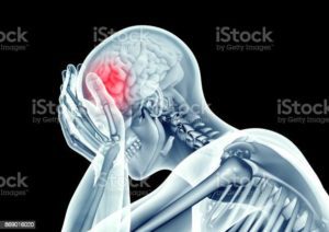stroke compensation claim denial by WorkCover Queensland